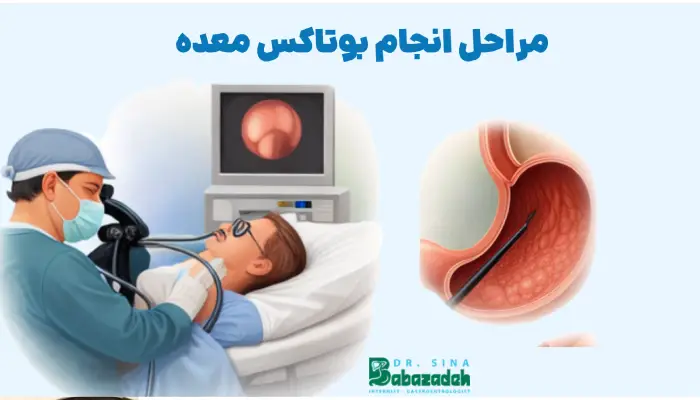 مراحل انجام بوتاکس معده